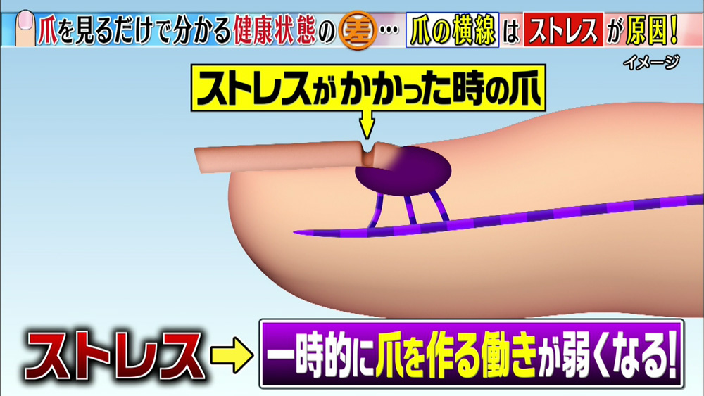 爪 でわかる健康セルフチェック 横線がある方 要注意です この差って何ですか ニュース テレビドガッチ