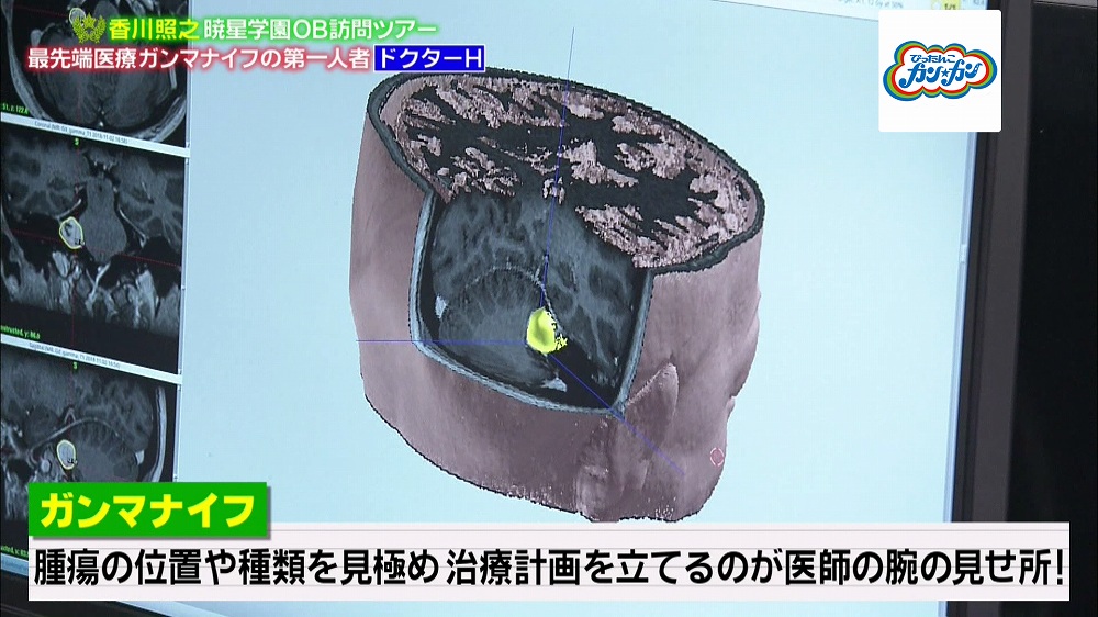 腫瘍だけを狙い撃ちして治療