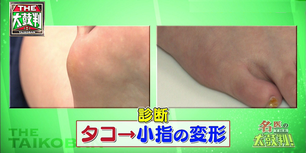 小指が使われずに変形